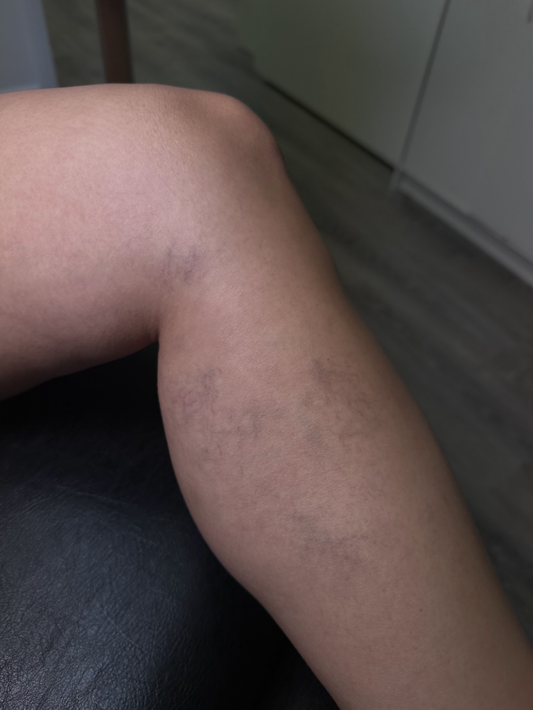 Sclerotherapy Boca Raton FL